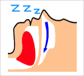 肥満や小あごのため舌が気道を塞いで呼吸がしにくい状態